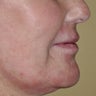 55 Year Old Female Treated For Facial Brown Spots