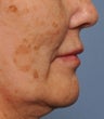 55 Year Old Female Treated For Facial Brown Spots