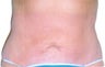 Smart Lipo