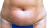 Smart Lipo