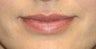 Lip filler with Juvederm