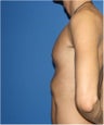 Pectoral Augmentation