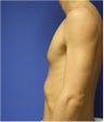 Pectoral Augmentation