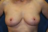 41 Year Old Female Bilateral Mastopexy
