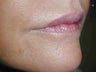 Juvederm and Botox to upper lip