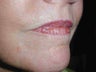 Juvederm and Botox to upper lip