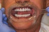 60 year old male treated with All-on-4 Dental Implant Procedure
