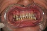 60 year old male treated with All-on-4 Dental Implant Procedure
