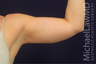 Arm Liposuction