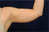 Arm Liposuction