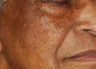 Patient Treated for Facial Moles