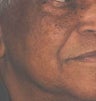 Patient Treated for Facial Moles