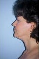 Neck Lift