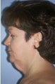 Neck Lift