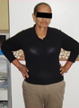 63 Year Old female treated for severe obesity