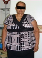 63 Year Old female treated for severe obesity