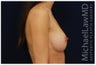 Breast Augmentation