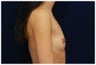 Breast Augmentation