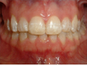 Invisalign