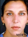 Female Primary Rhinoplasty