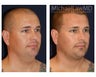 Chin Liposuction - Lower Facial Rejuvenation