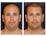Chin Liposuction - Lower Facial Rejuvenation