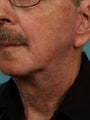 Neck lift for Men