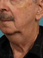 Neck lift for Men