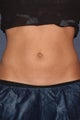 CoolSculpting 3 months later