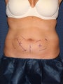 CoolSculpting 3 months later