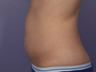 CoolSculpting to Abdomen