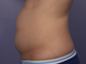 CoolSculpting to Abdomen
