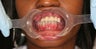 32 year old female treated with All-on-4 Dental Implant Procedure