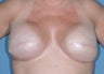 Breast Reconstruction