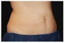CoolSculpting