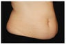 CoolSculpting
