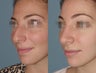 Female Patient, Early 20's, Treated for Lare Bump in Nose
