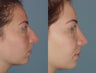 Female Patient, Early 20's, Treated for Lare Bump in Nose