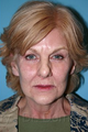 Facelift