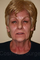 Facelift