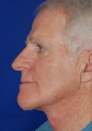 Neck Lift