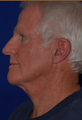 Neck Lift