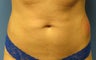 Female Coolsculpting on Abdomen