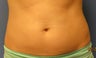 Female Coolsculpting on Abdomen