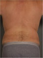 49 year old Male wanting to address excessive volume in waist / flank area to give him a more defined waist line