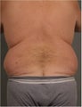 49 year old Male wanting to address excessive volume in waist / flank area to give him a more defined waist line