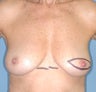 Breast Reconstruction
