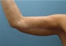58 Year Old Woman Treated For Arm Laxity