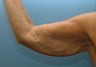 58 Year Old Woman Treated For Arm Laxity