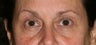 Restylane L to Tear trough